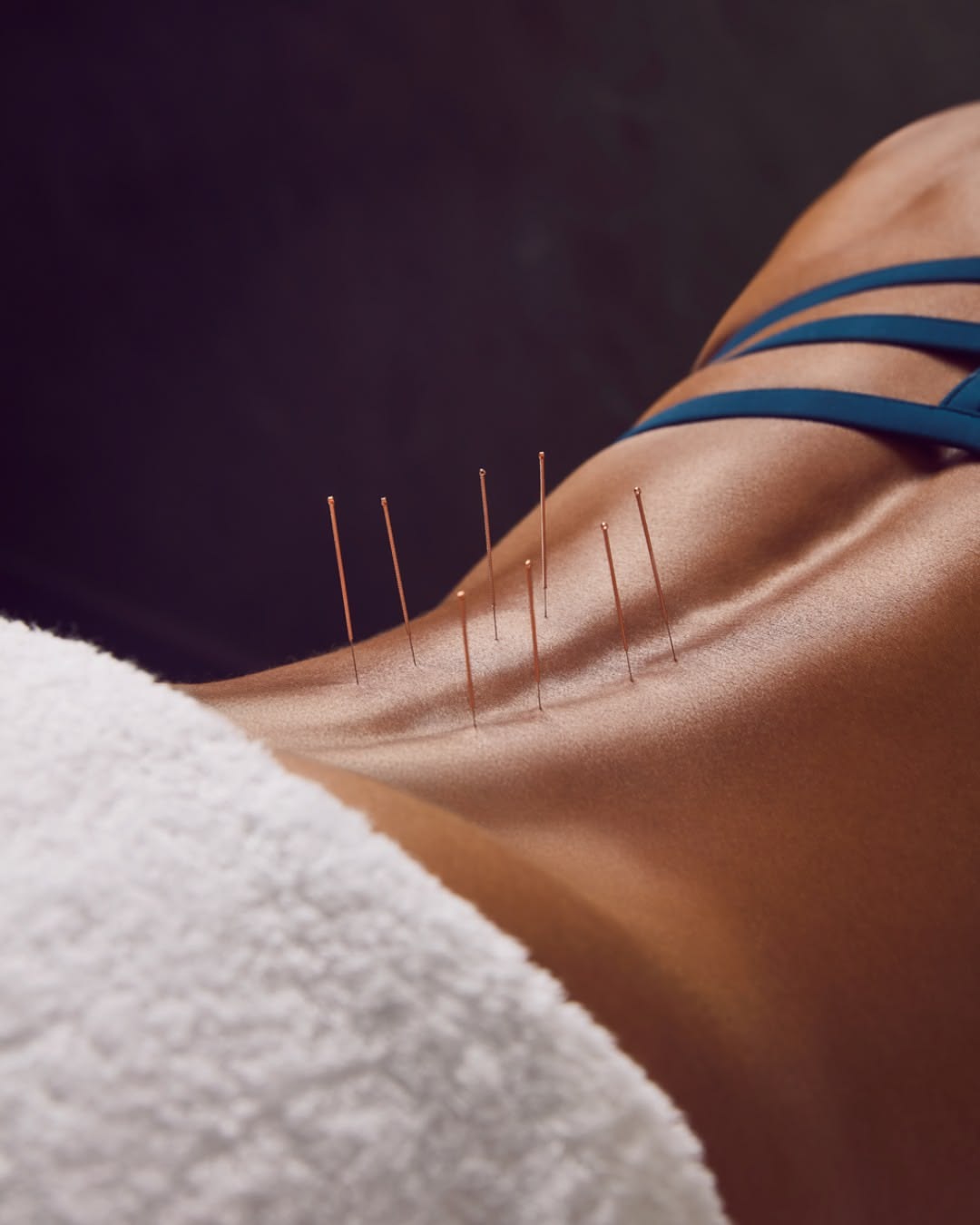 Método TMI — Dry Needling para Fisioterapeutas